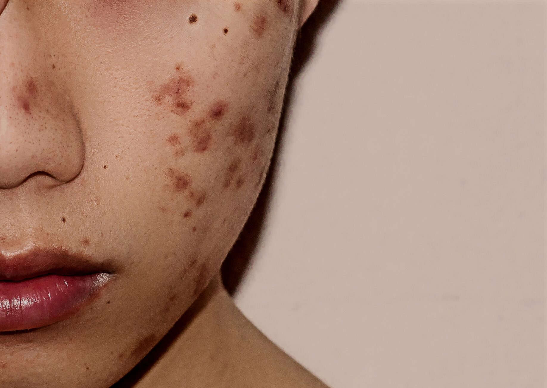 Person's Face with Acne Scars